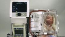 أطباء بريطانيون ينجحون في أول عملية لزراعة قلب "ميت" في أوروبا