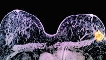 علاج جديد لسرطان الثدي "يُقلِّص الورم خلال 11 يوما"